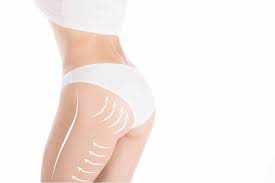Buttock augmentation